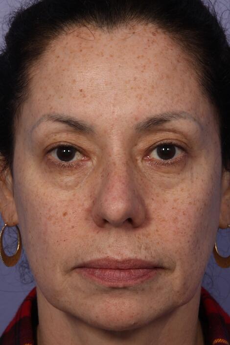 Laser Skin Resurfacing Before & After Image