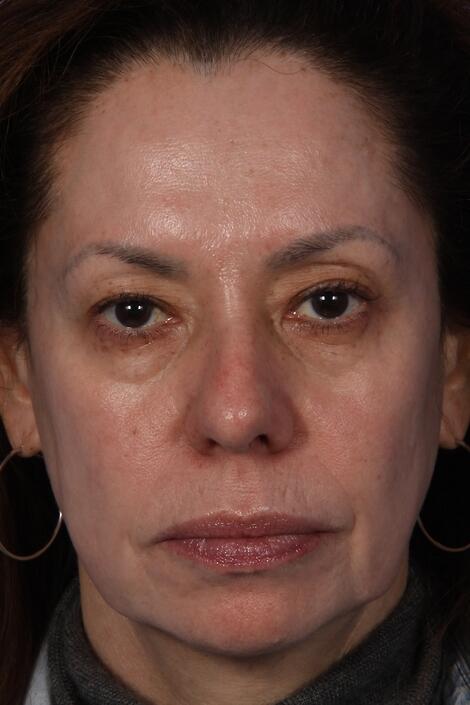 Laser Skin Resurfacing Before & After Image