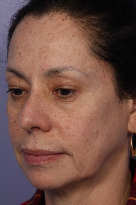 Laser Skin Resurfacing Before & After Image