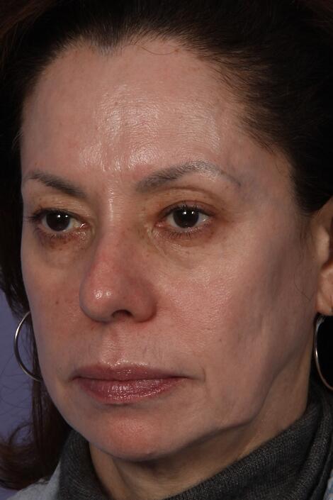 Laser Skin Resurfacing Before & After Image