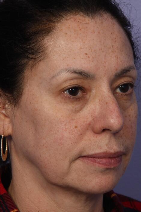 Laser Skin Resurfacing Before & After Image