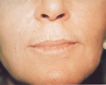 Laser Skin Resurfacing Before & After Image