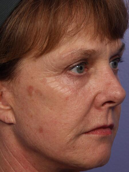 Laser Skin Resurfacing Before & After Image