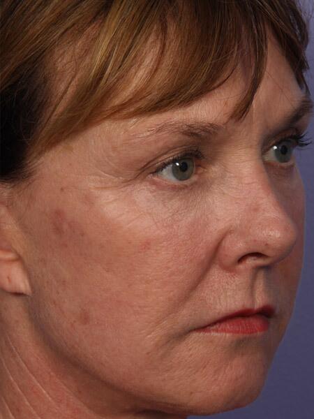 Laser Skin Resurfacing Before & After Image