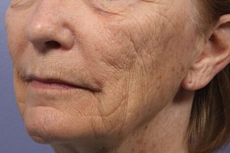 Laser Skin Resurfacing Before & After Image