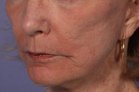 Laser Skin Resurfacing Before & After Image