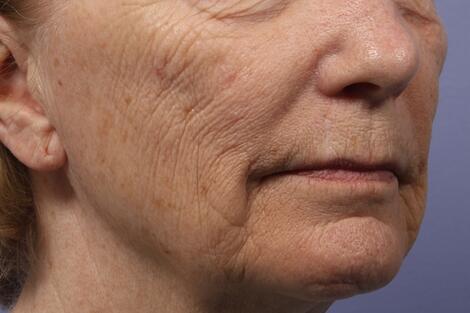 Laser Skin Resurfacing Before & After Image