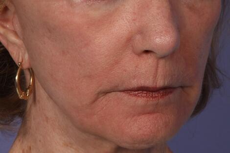 Laser Skin Resurfacing Before & After Image