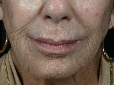 Laser Skin Resurfacing Before & After Image