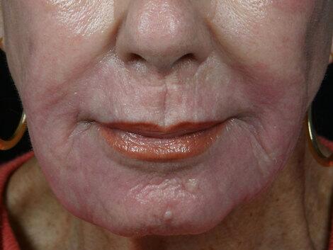 Laser Skin Resurfacing Before & After Image