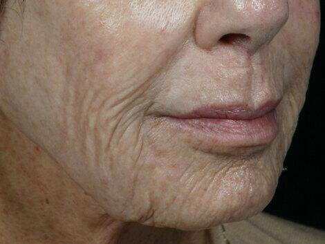 Laser Skin Resurfacing Before & After Image