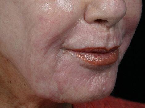 Laser Skin Resurfacing Before & After Image