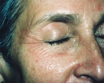 Laser Skin Resurfacing Before & After Image