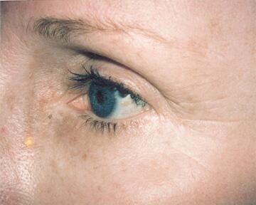 Laser Skin Resurfacing Before & After Image