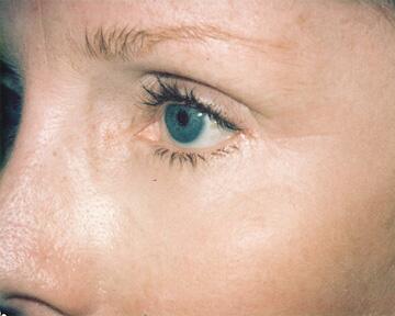 Laser Skin Resurfacing Before & After Image