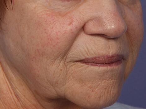 Laser Skin Resurfacing Before & After Image