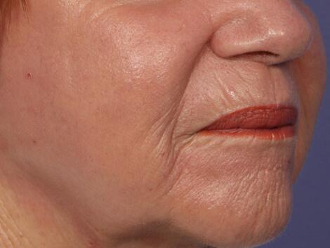 Laser Skin Resurfacing Before & After Image