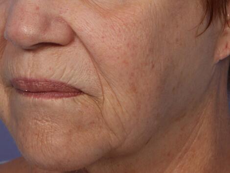 Laser Skin Resurfacing Before & After Image