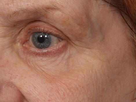 Laser Skin Resurfacing Before & After Image