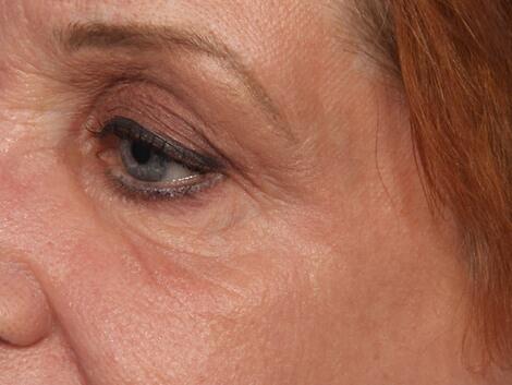 Laser Skin Resurfacing Before & After Image