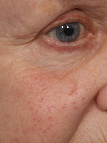 Laser Skin Resurfacing Before & After Image