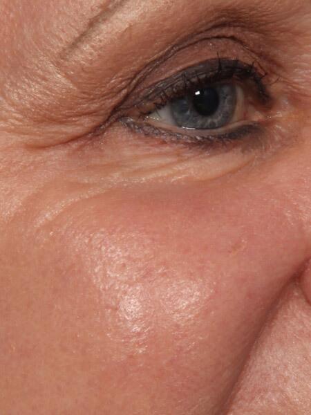 Laser Skin Resurfacing Before & After Image