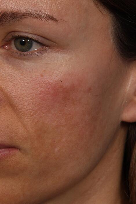 Laser Skin Resurfacing Before & After Image