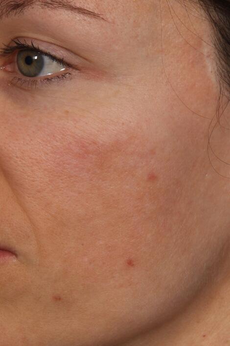 Laser Skin Resurfacing Before & After Image