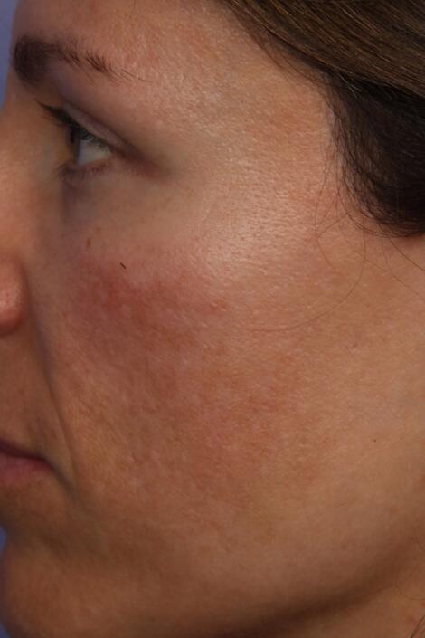 Laser Skin Resurfacing Before & After Image