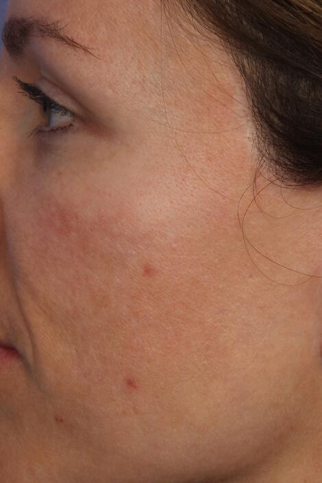 Laser Skin Resurfacing Before & After Image