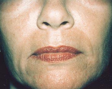 Laser Skin Resurfacing Before & After Image