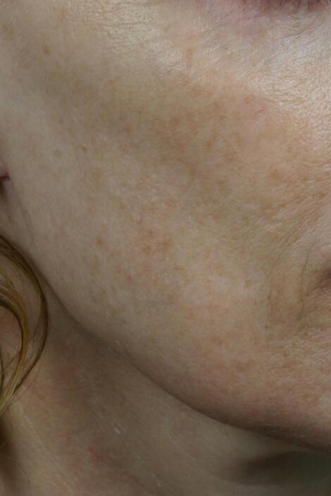 Laser Skin Resurfacing Before & After Image