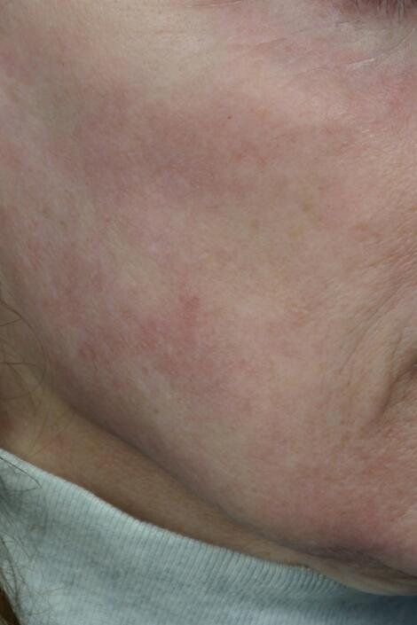 Laser Skin Resurfacing Before & After Image