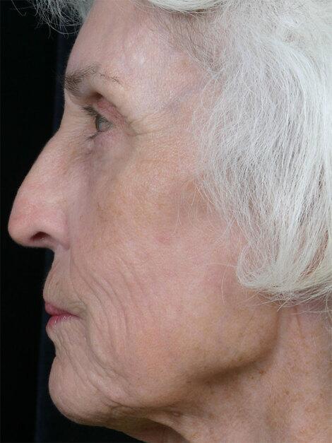 Laser Skin Resurfacing Before & After Image