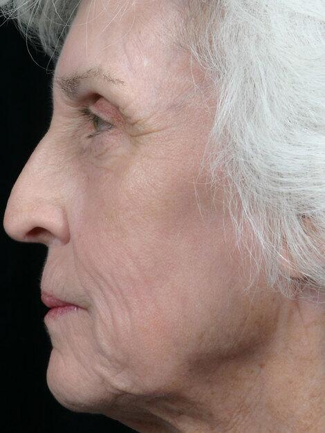 Laser Skin Resurfacing Before & After Image