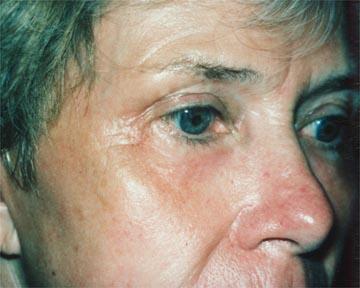 Laser Skin Resurfacing Before & After Image