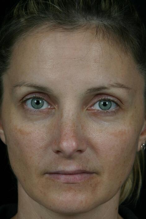 Laser Skin Resurfacing Before & After Image