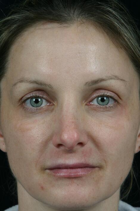 Laser Skin Resurfacing Before & After Image