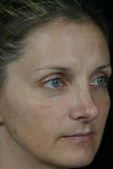 Laser Skin Resurfacing Before & After Image