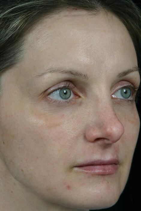 Laser Skin Resurfacing Before & After Image