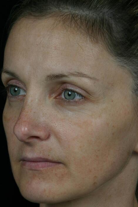 Laser Skin Resurfacing Before & After Image