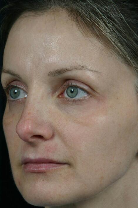 Laser Skin Resurfacing Before & After Image