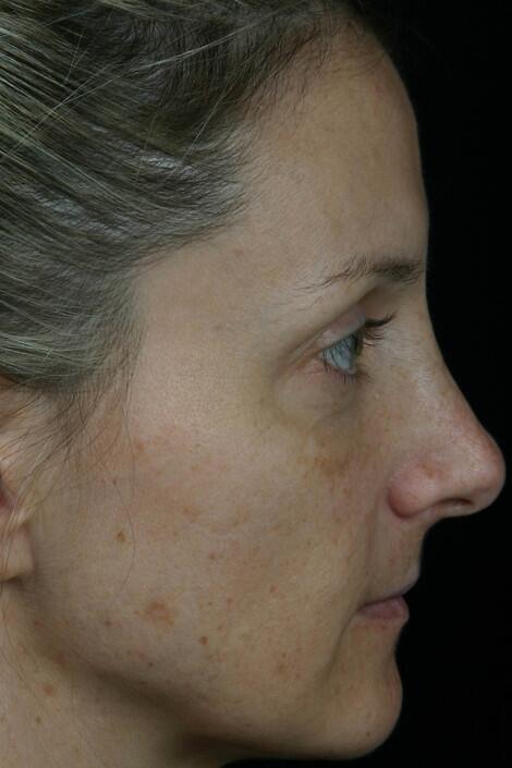 Laser Skin Resurfacing Before & After Image