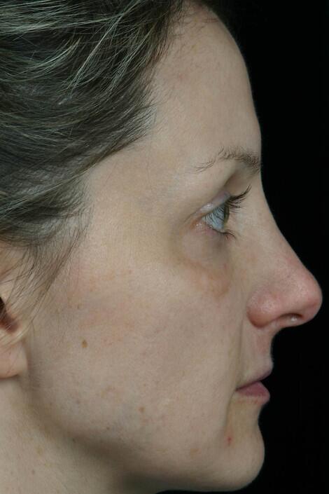 Laser Skin Resurfacing Before & After Image