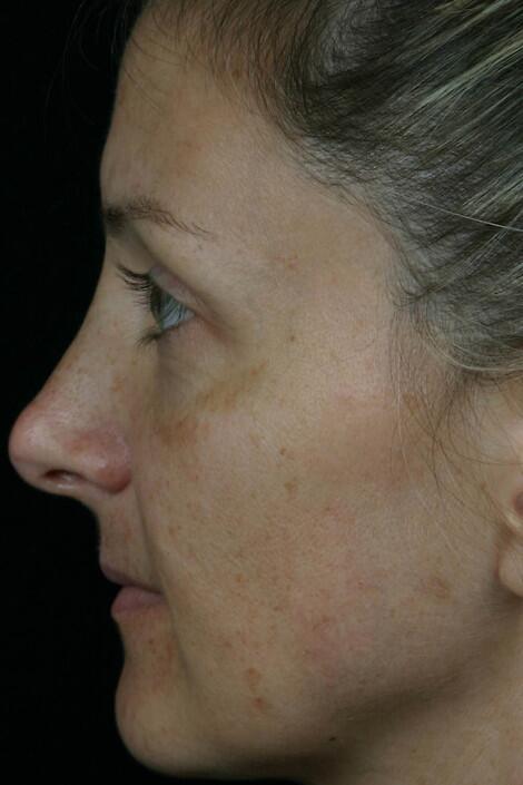 Laser Skin Resurfacing Before & After Image