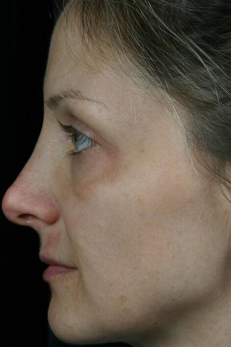 Laser Skin Resurfacing Before & After Image