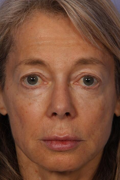 Laser Skin Resurfacing Before & After Image