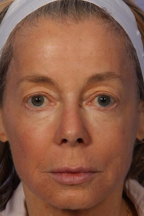 Laser Skin Resurfacing Before & After Image