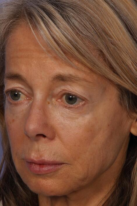 Laser Skin Resurfacing Before & After Image