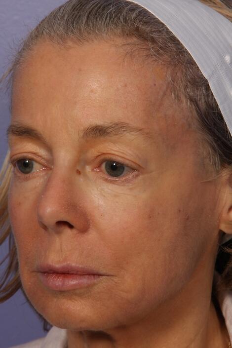 Laser Skin Resurfacing Before & After Image